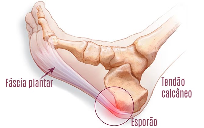 Fascite plantar ou tensão muscular? Aprenda a identificar e tratar dor no  pé - eu atleta